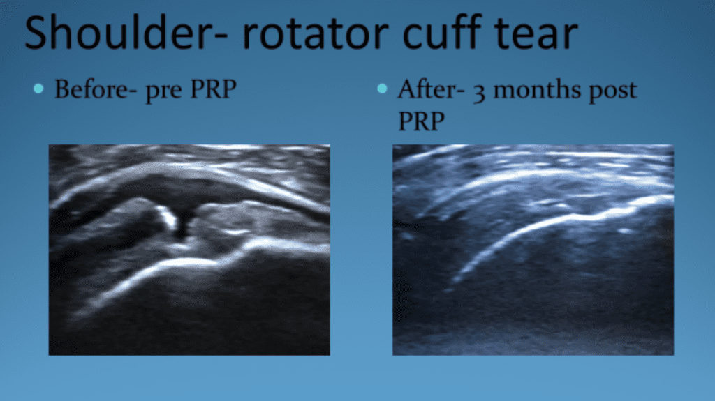 Shoulder-rotator cuff tear