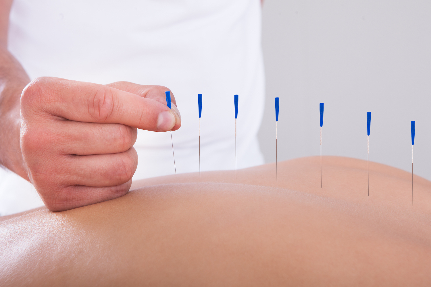 What a Trigger Point is and Why You Should Care? - Maynard Acupuncture